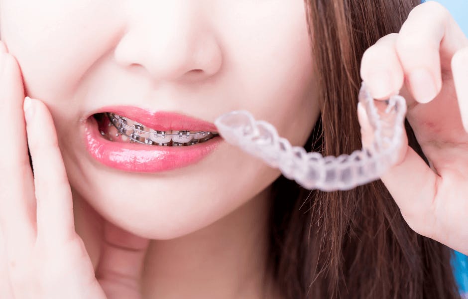 5 Benefits Of Having Invisible Braces For Crowded Teeth