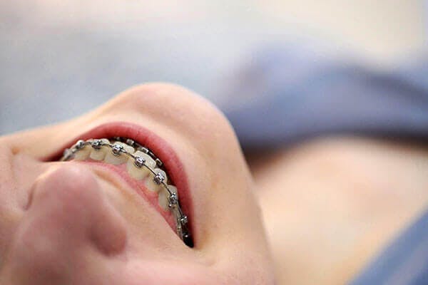 Kid-Friendly Invisalign